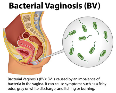 Bacterial Vaginosis (BV) infographic with explanation illustrationのイラスト素材