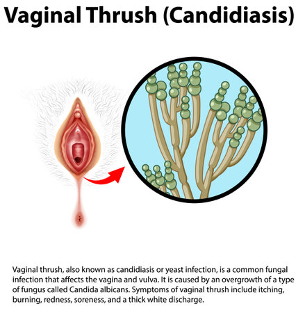 Vaginal Thrush (Candidiasis) infographic with explanation illustrationのイラスト素材