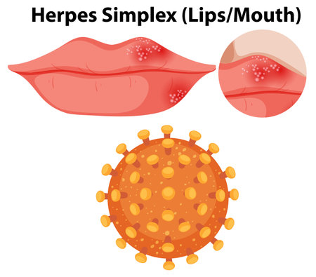 Herpes simplex virus (Lips/Mouth) illustrationのイラスト素材