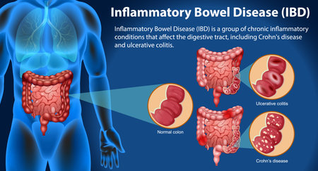 Inflammatory Bowel Disease (IBD) Infographic illustrationのイラスト素材