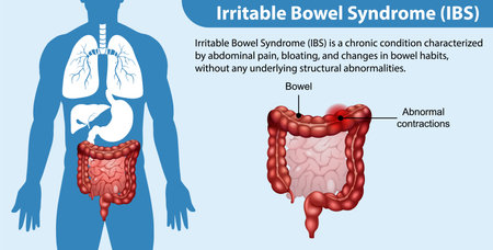 Irritable Bowel Syndrome (IBS) Infographic illustrationのイラスト素材