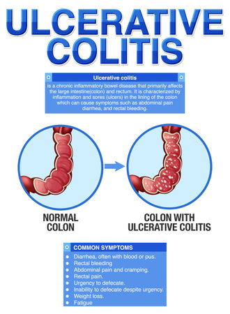 Ulcerative Colitis Symptoms Infographic illustrationのイラスト素材
