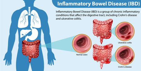 Inflammatory Bowel Disease (IBD) Infographic illustrationのイラスト素材