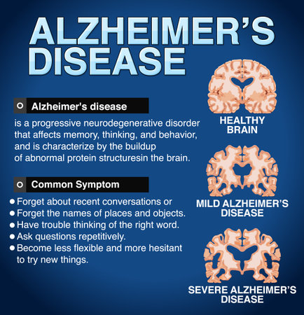 Informative poster of Alzheimers disease illustrationのイラスト素材
