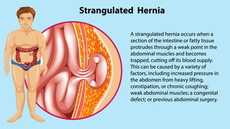 Causes of Strangulated Hernia Infographic illustrationのイラスト素材