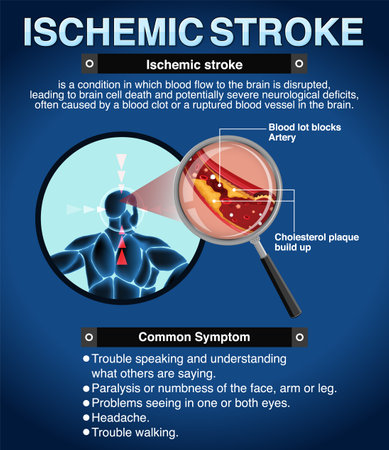 Informative poster of Ischemic stroke illustrationのイラスト素材