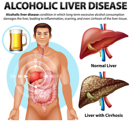 Informative poster of alcoholic liver disease Cirrhosis illustrationのイラスト素材