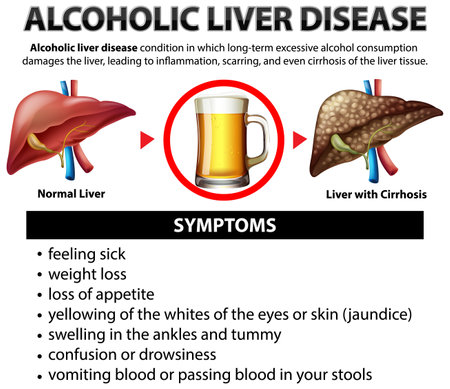 Informative poster of alcoholic liver disease Cirrhosis illustrationのイラスト素材