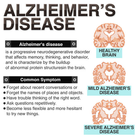 Informative poster of Alzheimers disease illustrationのイラスト素材