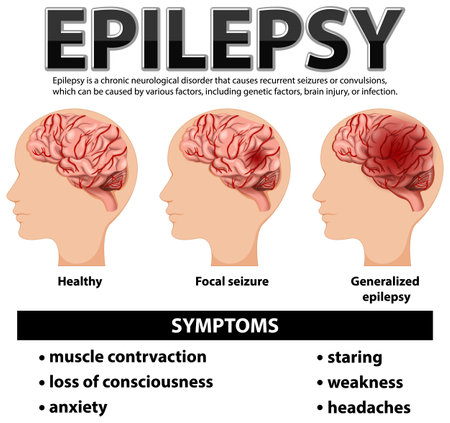Informative poster of Epilepsy illustrationのイラスト素材