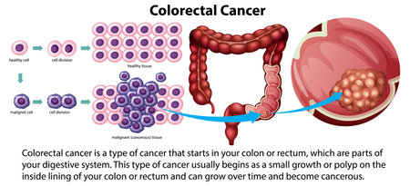 Colorectal Cancer with explanation illustrationのイラスト素材