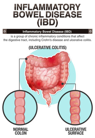 Inflammatory Bowel Disease (IBD) Infographic illustrationのイラスト素材