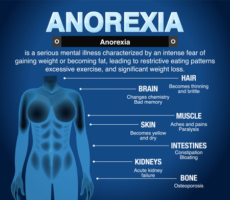 Informative poster of Anorexia eating disorder illustrationのイラスト素材