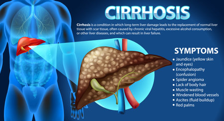 Informative poster of alcoholic liver disease Cirrhosis illustrationのイラスト素材