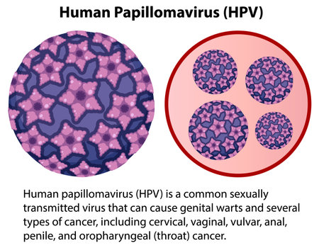 Human Papillomavirus with explanation illustrationのイラスト素材