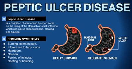 Peptic Ulcer Disease Explained Infographic illustrationのイラスト素材