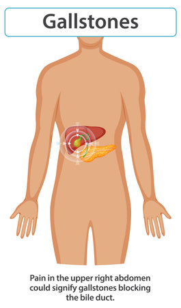 Illustration of gallstones affecting the human bodyのイラスト素材