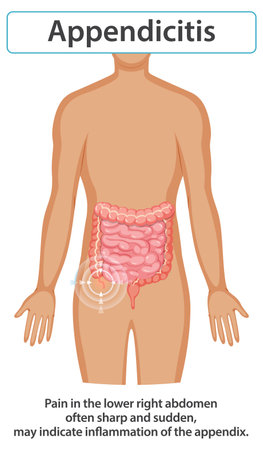 Diagram showing appendicitis location and symptomsのイラスト素材