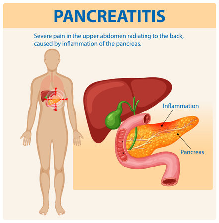 Illustration of pancreas inflammation and related painのイラスト素材