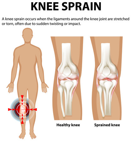 Illustration of healthy and sprained knee anatomyのイラスト素材