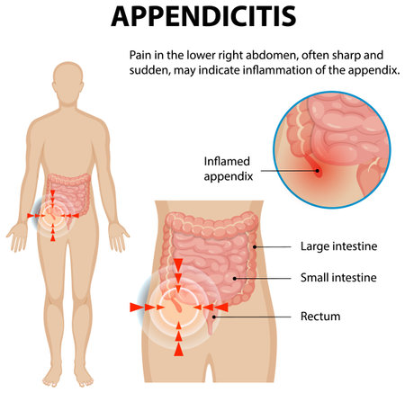 Illustration of appendicitis symptoms and affected organsのイラスト素材