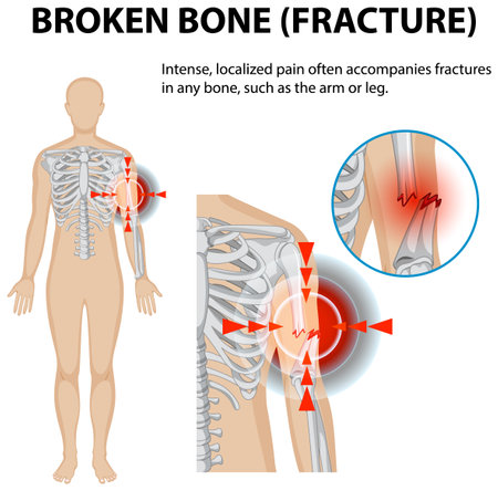 Illustration of fracture pain in human skeletonのイラスト素材
