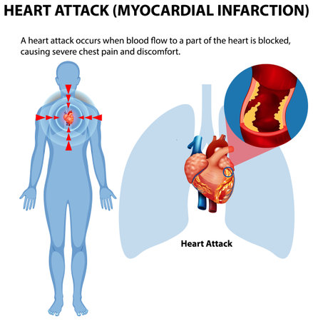 Illustration of heart attack symptoms and causesのイラスト素材
