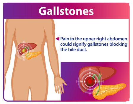 Illustration of gallstones causing abdominal painのイラスト素材