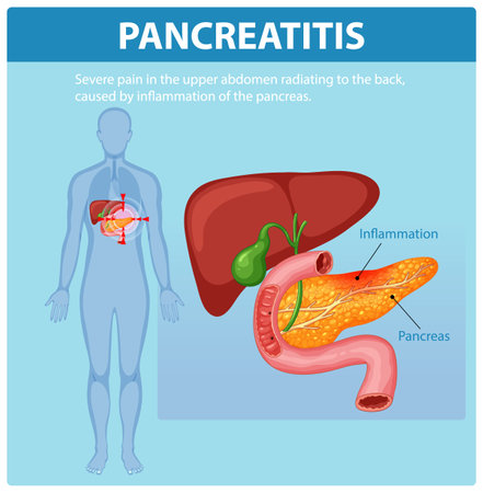 Illustration of pancreas inflammation and related painのイラスト素材