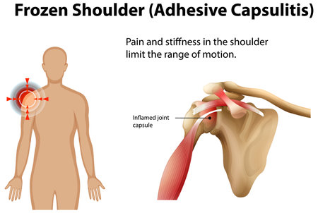 Illustration of shoulder pain and limited motionのイラスト素材