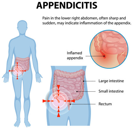 Illustration of inflamed appendix and abdominal painのイラスト素材