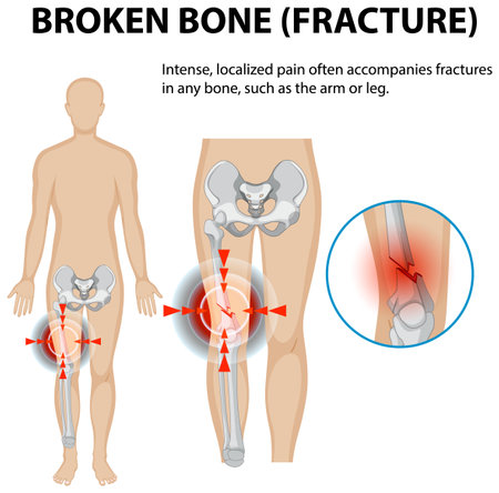 Illustration of bone fracture and associated painのイラスト素材