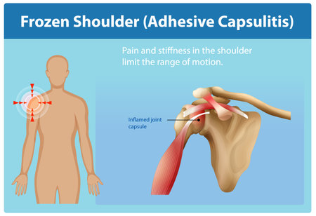 Illustration of shoulder pain and inflammation causesのイラスト素材