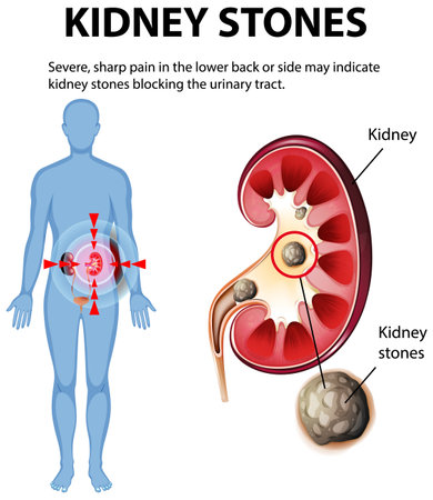 Illustration of kidney stones causing severe painのイラスト素材