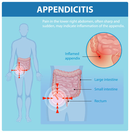 Illustration of appendicitis symptoms and affected areasのイラスト素材