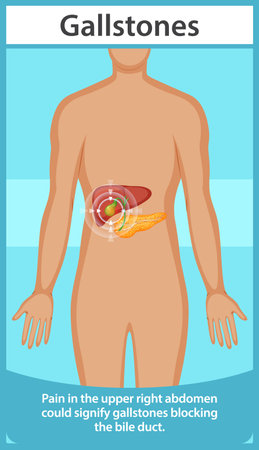 Illustration of gallstones affecting the bile ductのイラスト素材