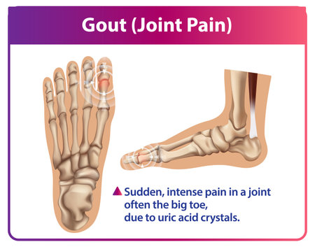 Illustration of gout affecting the foot jointsのイラスト素材