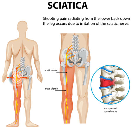 Illustration of sciatica nerve pain and spinal compressionのイラスト素材