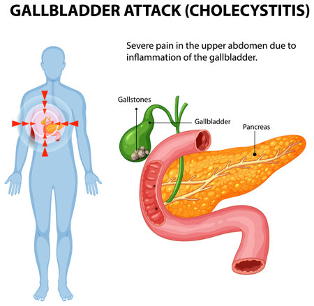 Illustration of gallbladder inflammation and abdominal painのイラスト素材