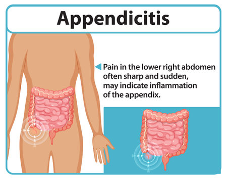 Illustration of appendicitis symptoms and affected areaのイラスト素材