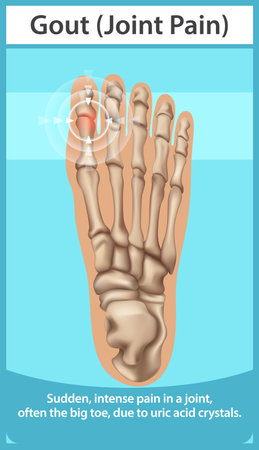 Illustration of gout affecting the big toe jointのイラスト素材