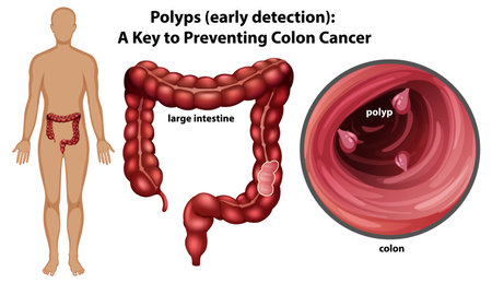 Illustration of colon polyps and early detectionのイラスト素材