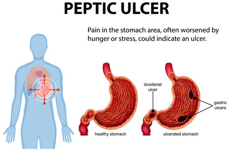 Illustration of stomach ulcers and related symptomsのイラスト素材
