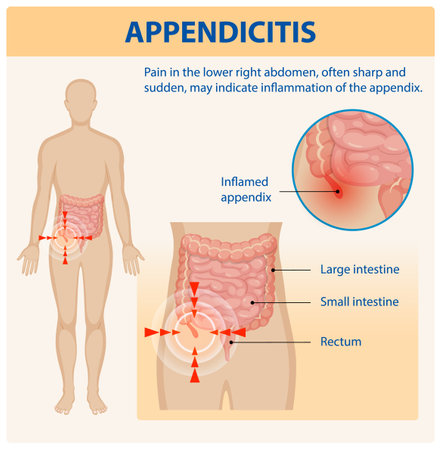 Illustration of appendicitis symptoms and affected organsのイラスト素材