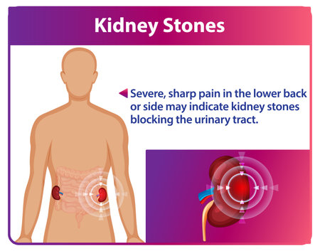 Illustration of kidney stones and associated painのイラスト素材