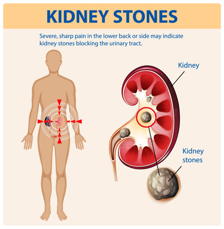 Illustration of kidney stones and associated painのイラスト素材
