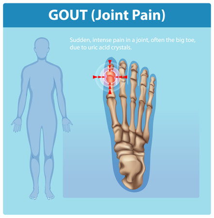 Illustration of gout affecting the big toe jointのイラスト素材
