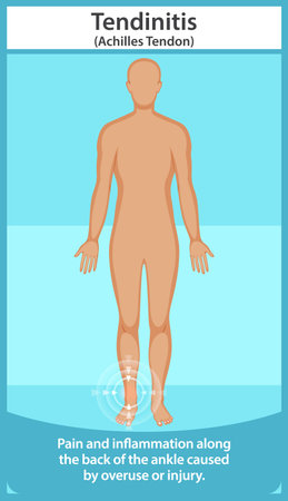 Depicts Achilles tendon pain and inflammationのイラスト素材