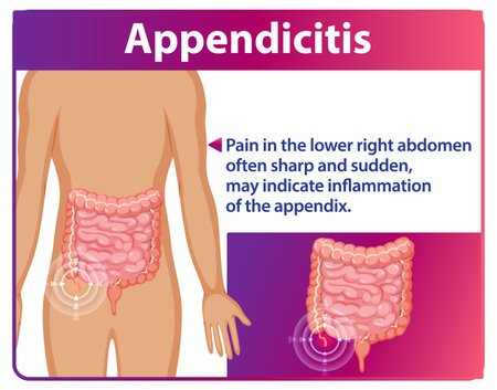 Illustration of appendicitis symptoms and affected areaのイラスト素材