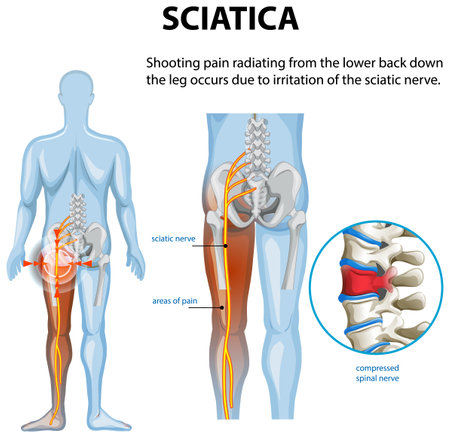 Illustration of sciatica pain and affected areasのイラスト素材